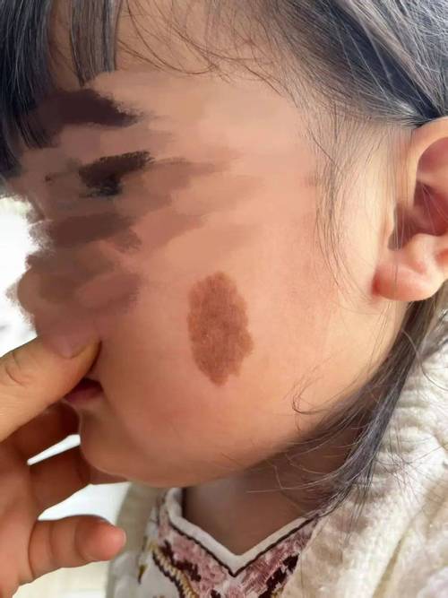 儿童脸上胎记会影响外貌吗？需要治疗吗？家长该如何正确应对？-第2张图片-郑州医学网