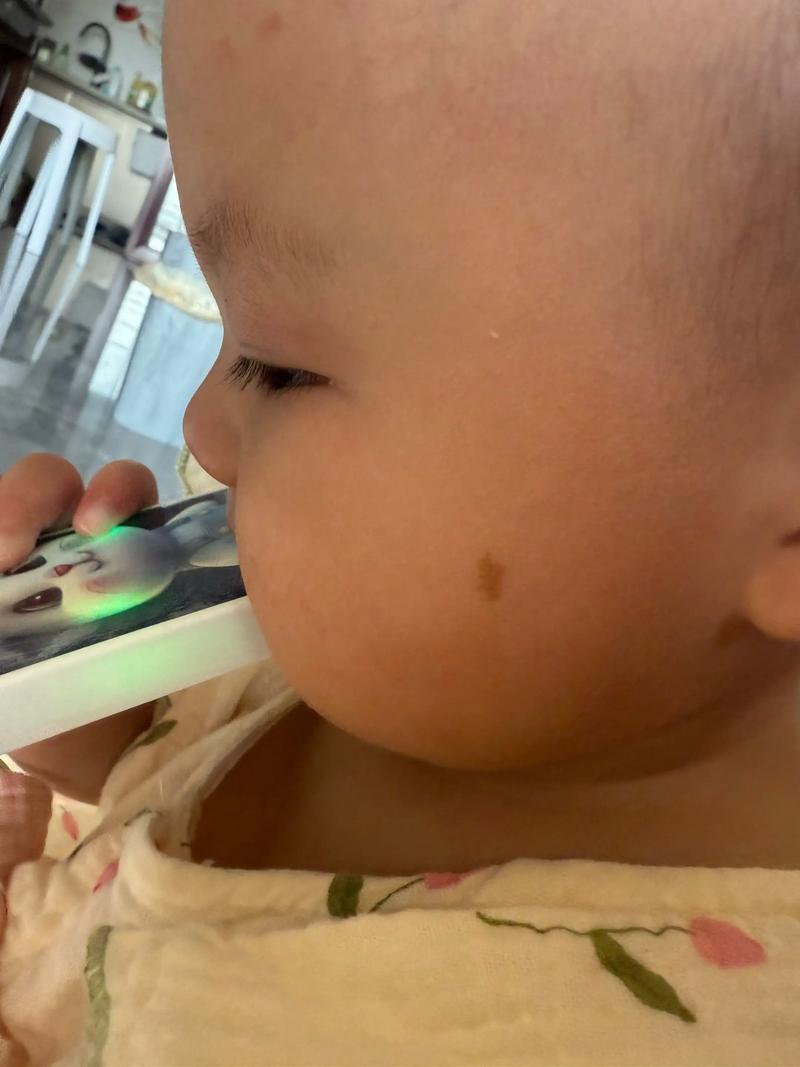 儿童脸上胎记会影响外貌吗？需要治疗吗？家长该如何正确应对？-第3张图片-郑州医学网