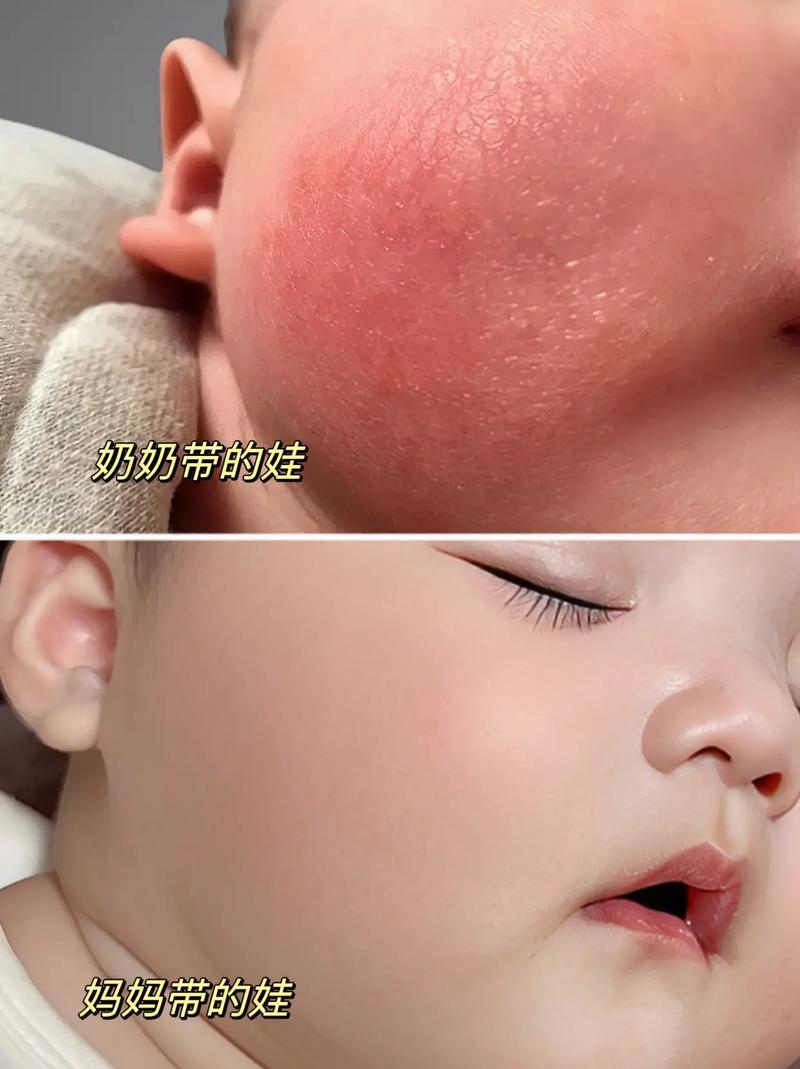 新生儿脸干起皮是缺水还是生病？如何正确护理避免皮肤受损？-第1张图片-郑州医学网