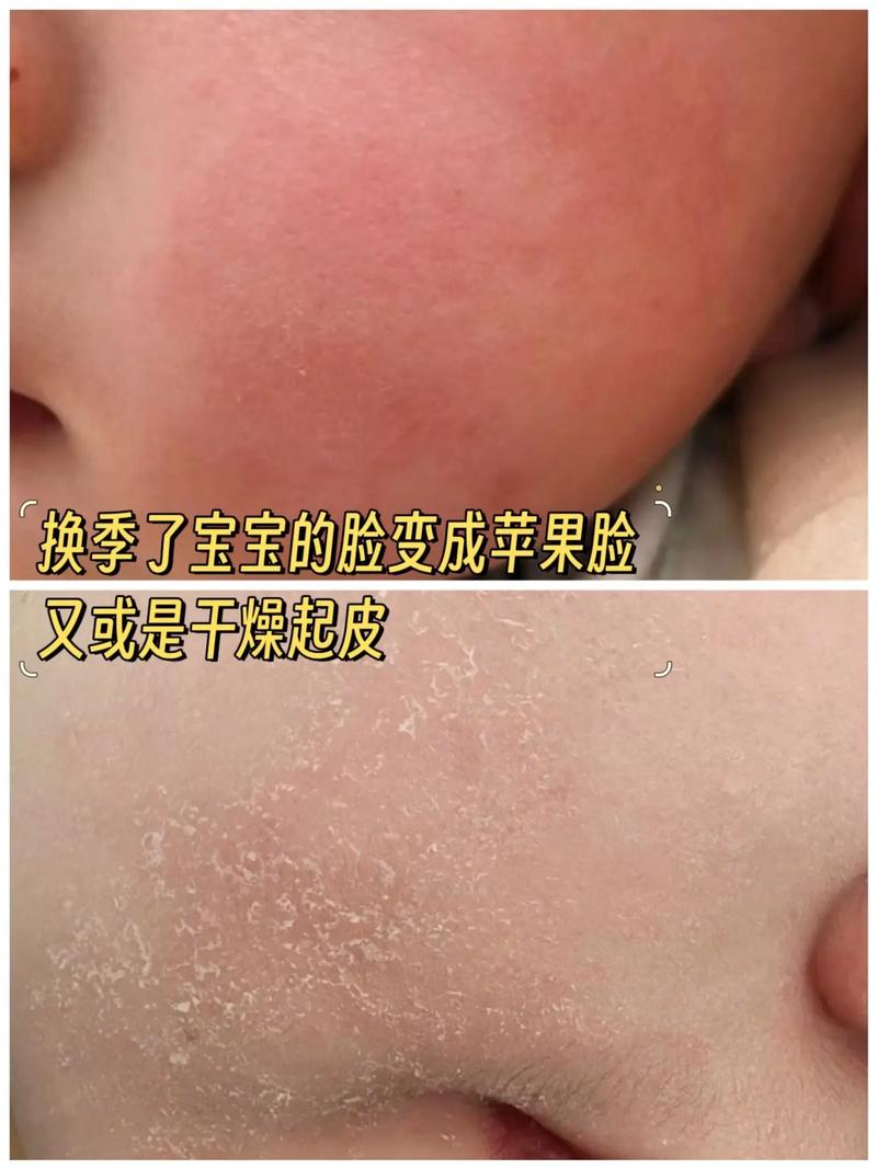 新生儿脸干起皮是缺水还是生病？如何正确护理避免皮肤受损？-第2张图片-郑州医学网