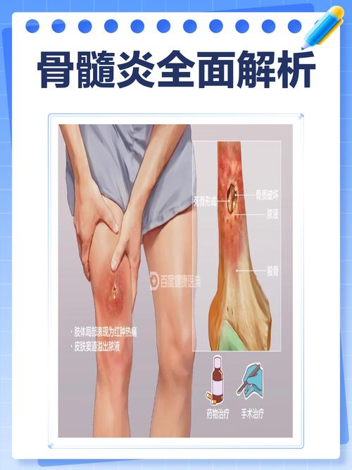 儿童骨髓炎的发病原因有哪些?常见诱因与预防措施是什么?-第2张图片-郑州医学网 儿童骨髓炎的发病原因有哪些?常见诱因与预防措施是什么?-第2张图片-郑州医学网