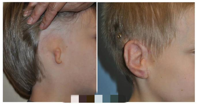 新生儿两个耳朵不对称是发育异常还是正常现象?需要干预吗?-第1张图片-郑州医学网 新生儿两个耳朵不对称是发育异常还是正常现象?需要干预吗?-第1张图片-郑州医学网