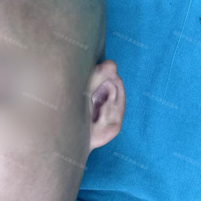 新生儿两个耳朵不对称是发育异常还是正常现象?需要干预吗?-第2张图片-郑州医学网 新生儿两个耳朵不对称是发育异常还是正常现象?需要干预吗?-第2张图片-郑州医学网