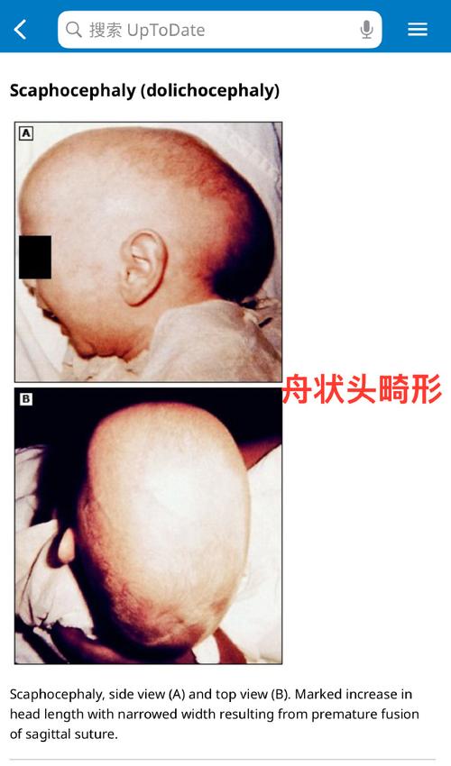 新生儿两侧头凹凸不平是正常现象吗?需要警惕哪些潜在问题?-第2张图片-郑州医学网 新生儿两侧头凹凸不平是正常现象吗?需要警惕哪些潜在问题?-第2张图片-郑州医学网