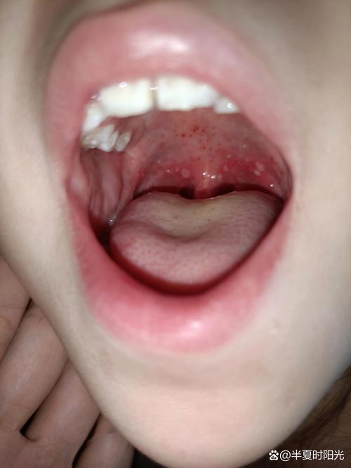 儿童儿童疱疹性咽喉炎图片长什么样？如何辨别与普通咽喉炎的区别？-第2张图片-郑州医学网