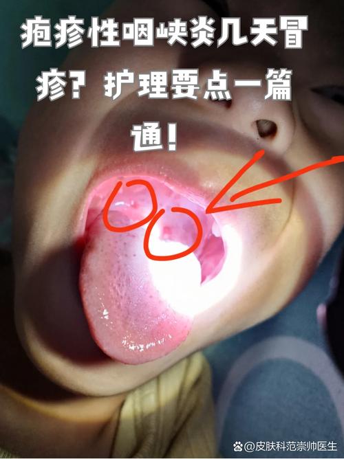 儿童儿童疱疹性咽喉炎图片长什么样？如何辨别与普通咽喉炎的区别？-第3张图片-郑州医学网