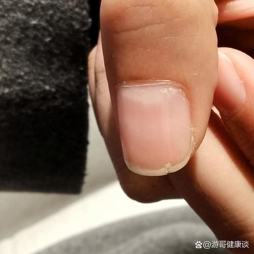 10岁儿童指甲出现竖纹是营养不良还是疾病信号？-第3张图片-郑州医学网