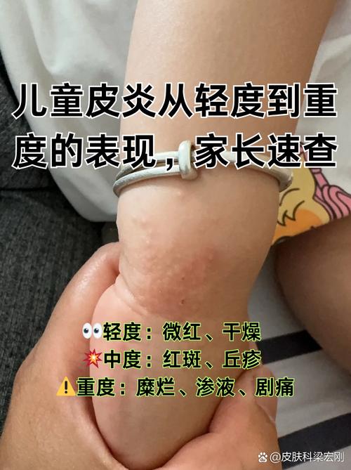 儿童风湿免疫病的症状有哪些容易被家长忽视？如何早期识别与干预？-第2张图片-郑州医学网