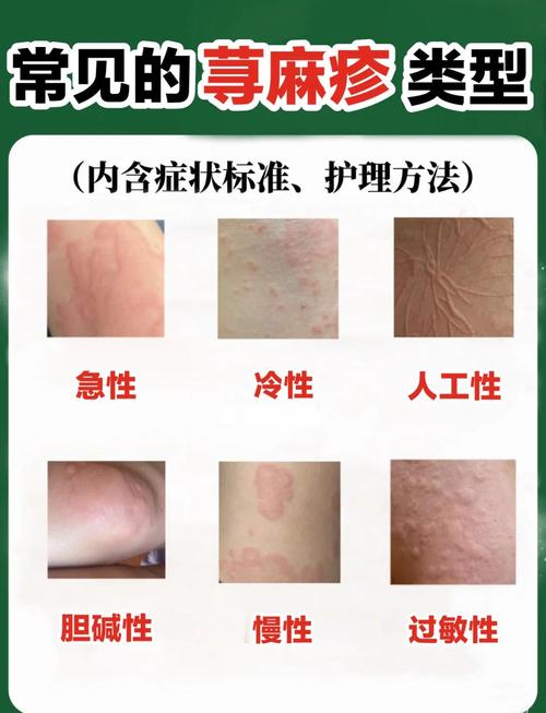儿童荨麻疹症状多样，究竟哪些原因会悄悄引发皮肤红肿瘙痒？-第1张图片-郑州医学网