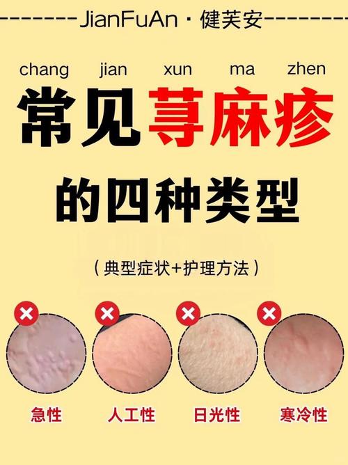 儿童荨麻疹频发,究竟哪些隐形推手在悄悄作祟?-第1张图片-郑州医学网 儿童荨麻疹频发,究竟哪些隐形推手在悄悄作祟?-第1张图片-郑州医学网