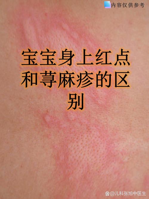 儿童荨麻疹频发,究竟哪些隐形推手在悄悄作祟?-第2张图片-郑州医学网 儿童荨麻疹频发,究竟哪些隐形推手在悄悄作祟?-第2张图片-郑州医学网