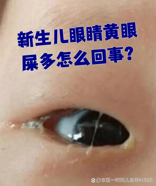 新生儿眼睛发黄到底严不严重？需要立即就医还是能自行消退？-第1张图片-郑州医学网