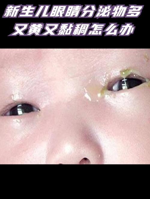 新生儿眼睛发黄到底严不严重？需要立即就医还是能自行消退？-第3张图片-郑州医学网