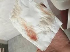 孕期大便带白色分泌物是感染还是正常孕期变化？需警惕哪些妇科或肠道问题？-第1张图片-郑州医学网