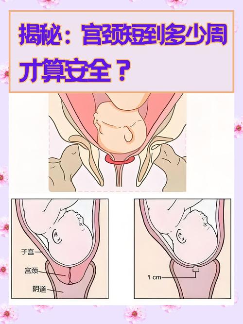 孕期宫颈长度37mm正常吗？对胎儿发育有影响吗？需要怎么保胎？-第1张图片-郑州医学网