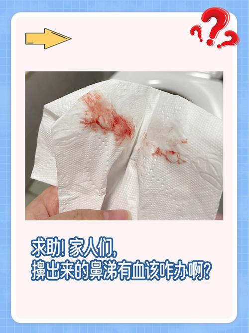 孕期鼻子和喉咙总出血，是正常生理反应还是危险信号？-第3张图片-郑州医学网