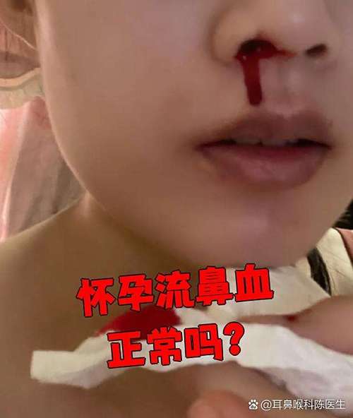 孕期鼻子和喉咙总出血，是正常生理反应还是危险信号？-第2张图片-郑州医学网