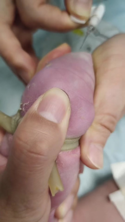 新生儿呛羊水后会出现哪些危险症状？家长该如何紧急处理？-第3张图片-郑州医学网