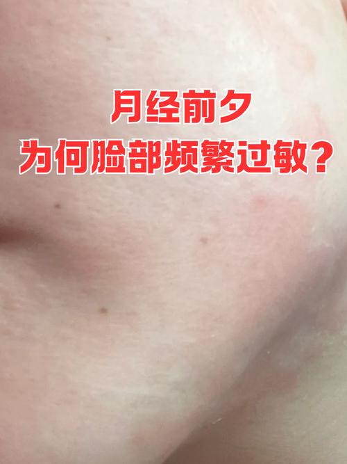 孕期脸过敏泛红怎么办？安全有效的护肤方法有哪些？-第3张图片-郑州医学网