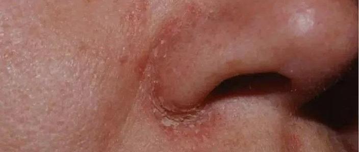 孕期过敏性鼻炎鼻子干,该如何安全缓解不适?-第1张图片-郑州医学网 孕期过敏性鼻炎鼻子干,该如何安全缓解不适?-第1张图片-郑州医学网