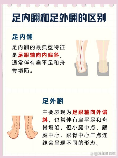 儿童外八字脚矫正的最佳方法有哪些？家长如何科学干预？-第2张图片-郑州医学网