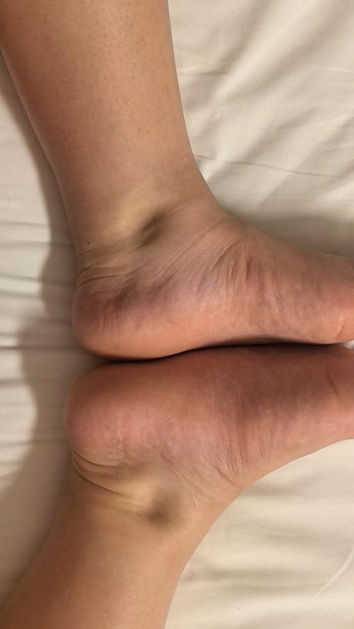 孕期不安腿综合征症状有哪些表现?对胎儿和孕妇健康有影响吗?-第1张图片-郑州医学网 孕期不安腿综合征症状有哪些表现?对胎儿和孕妇健康有影响吗?-第1张图片-郑州医学网