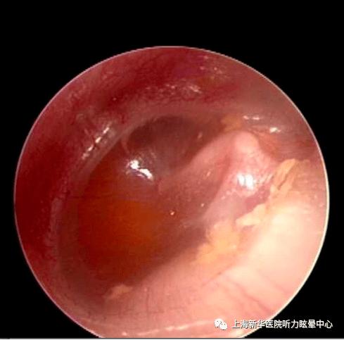 孕期得了分泌性中耳炎，会对胎儿有影响吗？该怎么治疗才安全？-第2张图片-郑州医学网