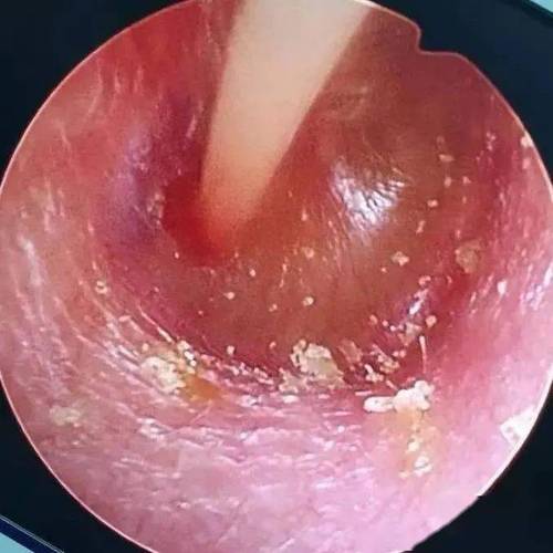 孕期得了分泌性中耳炎，会对胎儿有影响吗？该怎么治疗才安全？-第1张图片-郑州医学网