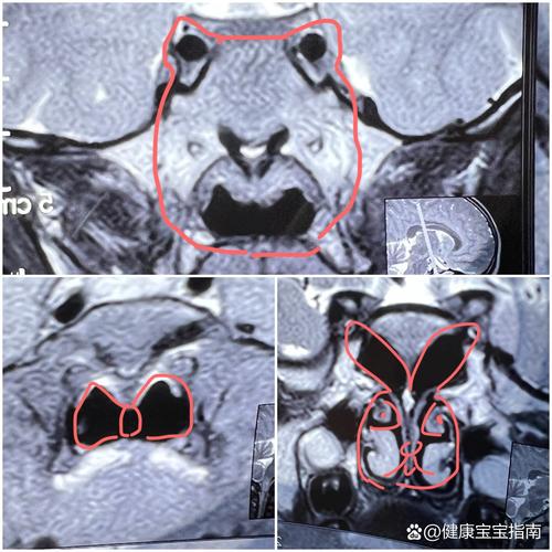 儿童做核磁共振安全吗？家长需注意哪些事项？-第2张图片-郑州医学网