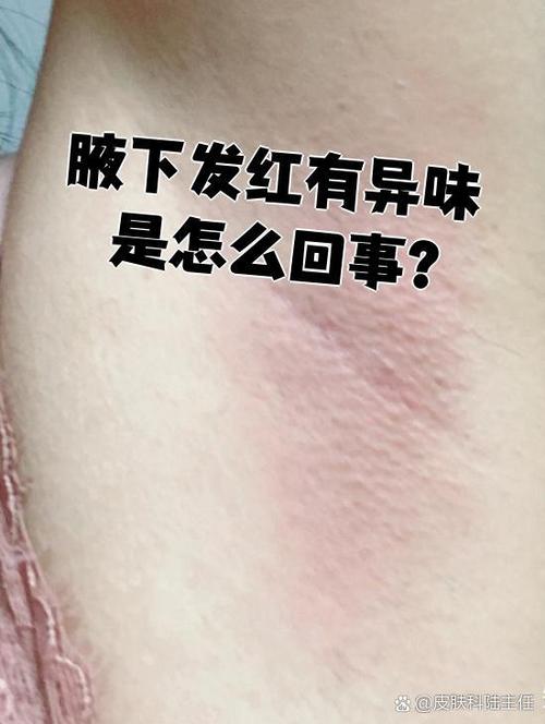 孕期腋下异味是激素变化还是代谢异常？该怎么护理才安心？-第1张图片-郑州医学网