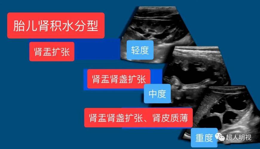 孕期双肾集合系统分离会自行消失吗？对胎儿发育有影响吗？需要治疗吗？-第2张图片-郑州医学网