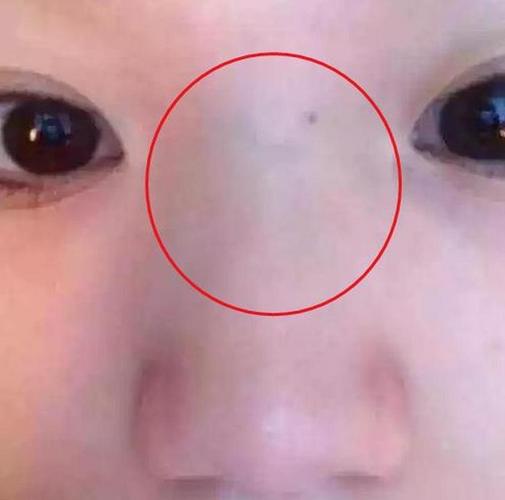 新生儿鼻子中间有条线是正常现象吗?会影响颜值或健康吗?-第1张图片-郑州医学网 新生儿鼻子中间有条线是正常现象吗?会影响颜值或健康吗?-第1张图片-郑州医学网