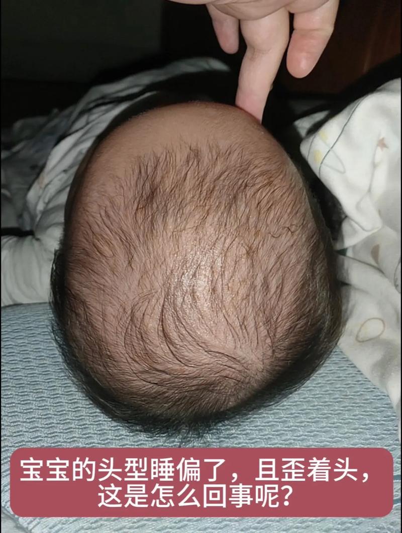 新生儿睡觉头总歪一边是正常现象吗?需要干预吗?-第1张图片-郑州医学网 新生儿睡觉头总歪一边是正常现象吗?需要干预吗?-第1张图片-郑州医学网