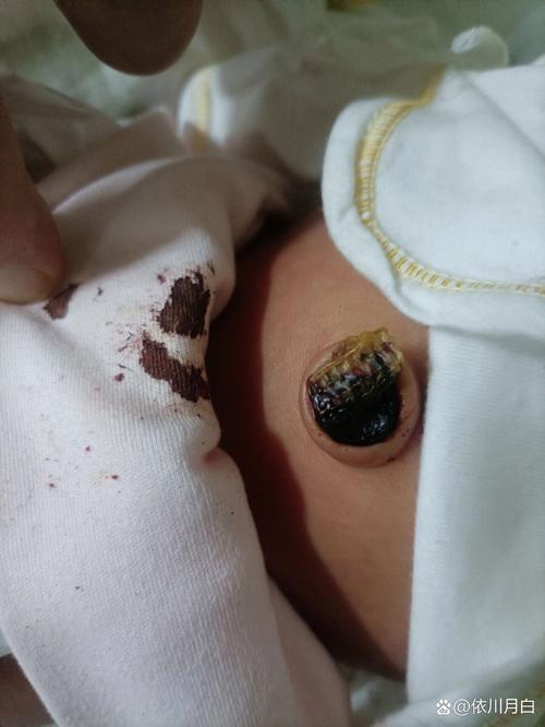 新生儿十天脐带渗血正常吗？需要处理吗？-第1张图片-郑州医学网