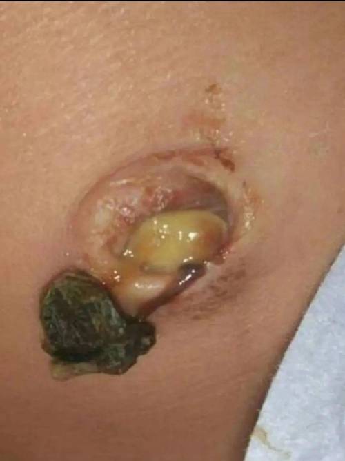 新生儿十天脐带渗血正常吗？需要处理吗？-第2张图片-郑州医学网