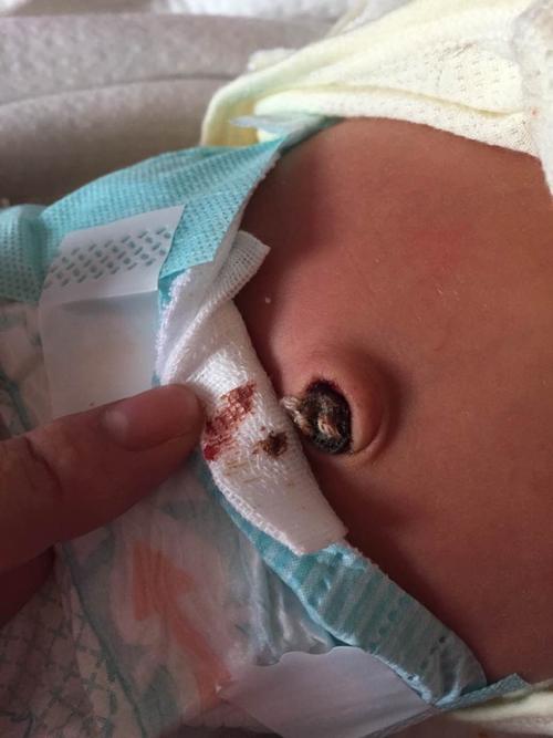 新生儿十天脐带渗血正常吗？需要处理吗？-第3张图片-郑州医学网