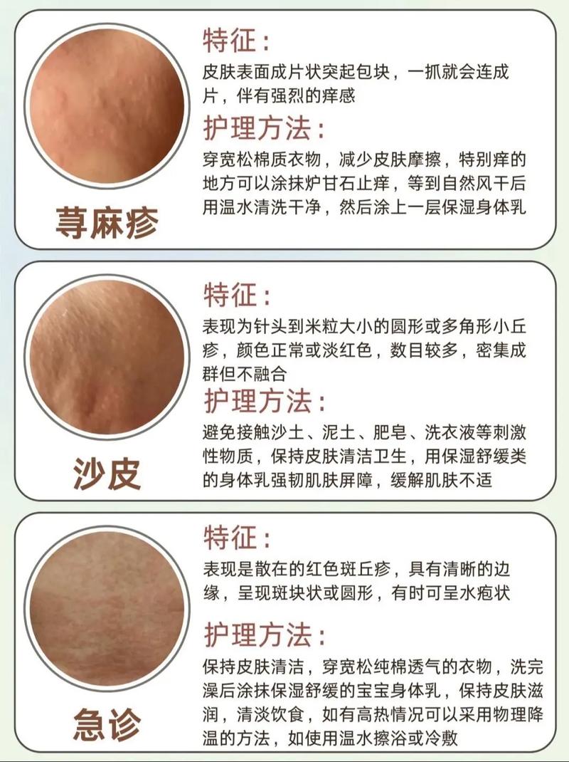 儿童单纯糠疹怎么治疗-第2张图片-郑州医学网