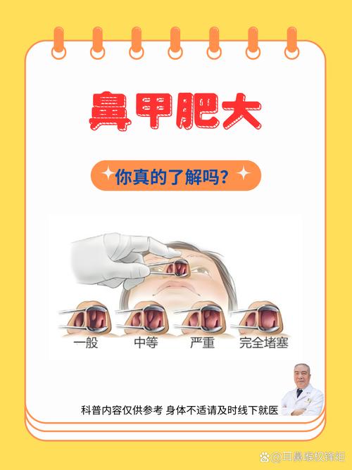 儿童下鼻甲肥大到底该如何科学处理？-第2张图片-郑州医学网