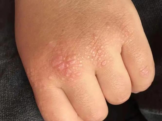 儿童肌炎有哪些典型症状?治疗时如何兼顾疗效与安全性?-第1张图片-郑州医学网 儿童肌炎有哪些典型症状?治疗时如何兼顾疗效与安全性?-第1张图片-郑州医学网