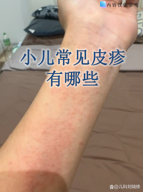 儿童肌炎有哪些典型症状?治疗时如何兼顾疗效与安全性?-第2张图片-郑州医学网 儿童肌炎有哪些典型症状?治疗时如何兼顾疗效与安全性?-第2张图片-郑州医学网