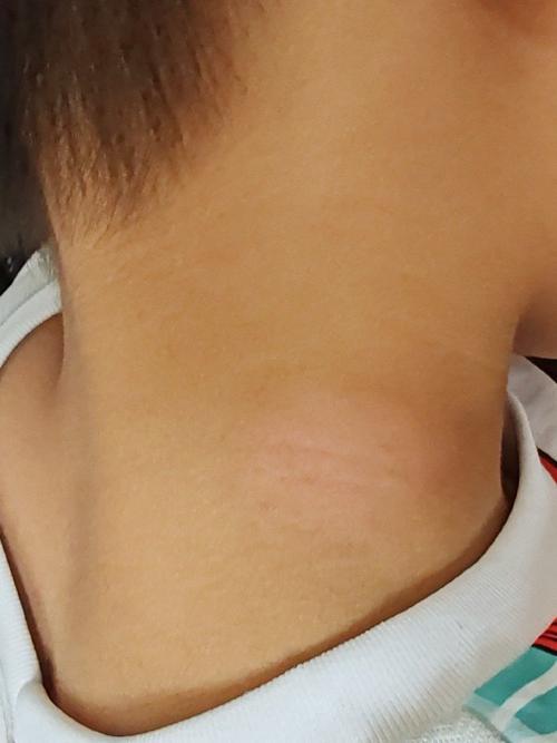 儿童颈部淋巴结肿大图,哪些情况需警惕?如何判断正常与异常?-第2张图片-郑州医学网 儿童颈部淋巴结肿大图,哪些情况需警惕?如何判断正常与异常?-第2张图片-郑州医学网