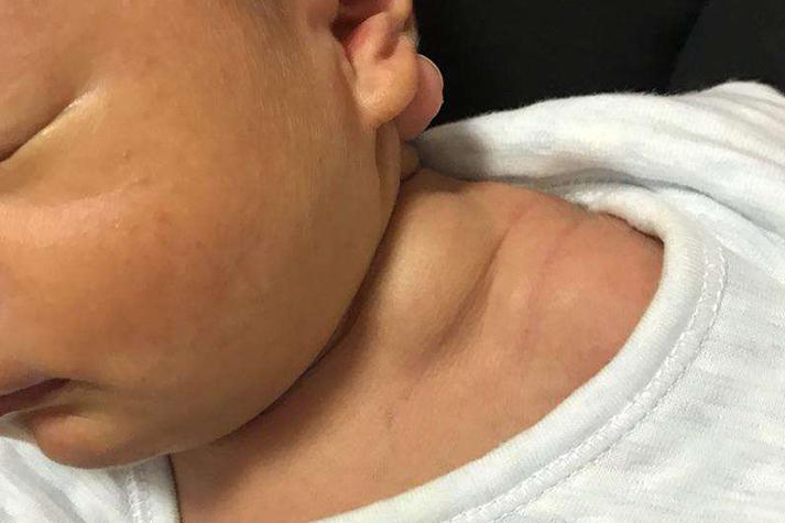 儿童颈部淋巴结肿大图，哪些情况需警惕？如何判断正常与异常？-第3张图片-郑州医学网