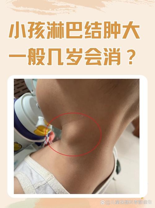 儿童颈部淋巴结肿大图,哪些情况需警惕?如何判断正常与异常?-第1张图片-郑州医学网 儿童颈部淋巴结肿大图,哪些情况需警惕?如何判断正常与异常?-第1张图片-郑州医学网
