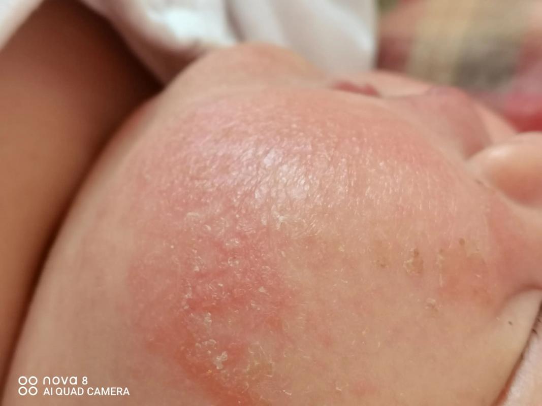 新生儿毛囊炎到底能不能自愈?家长需要干预吗?-第1张图片-郑州医学网 新生儿毛囊炎到底能不能自愈?家长需要干预吗?-第1张图片-郑州医学网