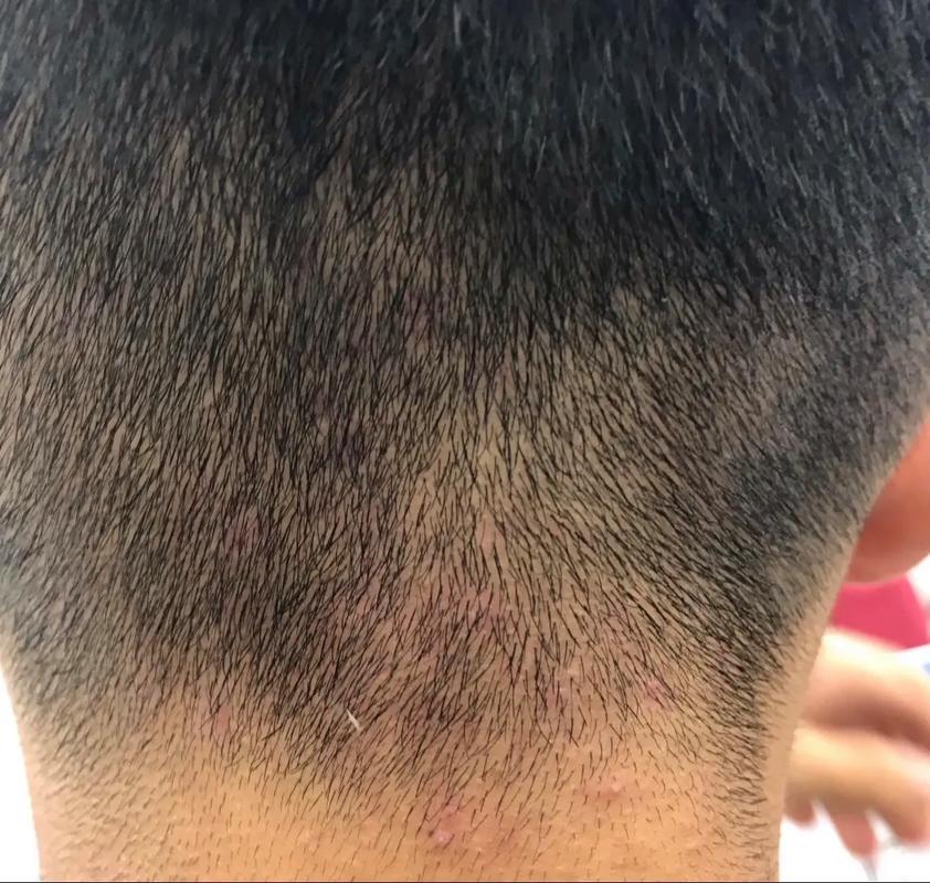 新生儿毛囊炎到底能不能自愈？家长需要干预吗？-第2张图片-郑州医学网