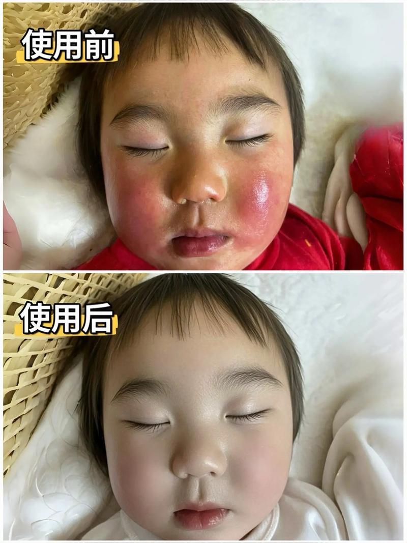 新生儿脸怎么越来越黑？是正常现象还是健康信号？需要干预吗？-第3张图片-郑州医学网