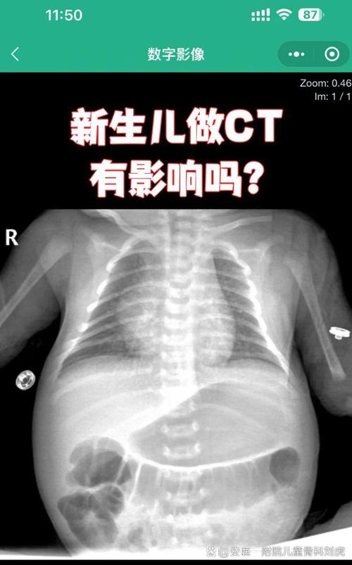 新生儿做ct查什么的-第1张图片-郑州医学网