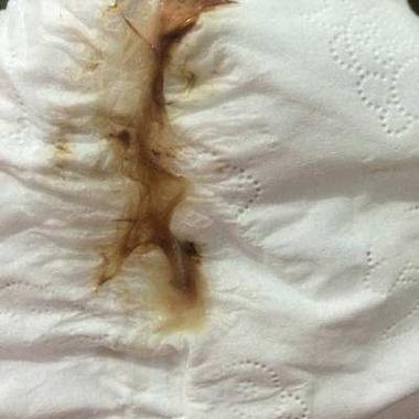 孕期反复出现褐色分泌物，是先兆流产还是其他异常信号？-第1张图片-郑州医学网