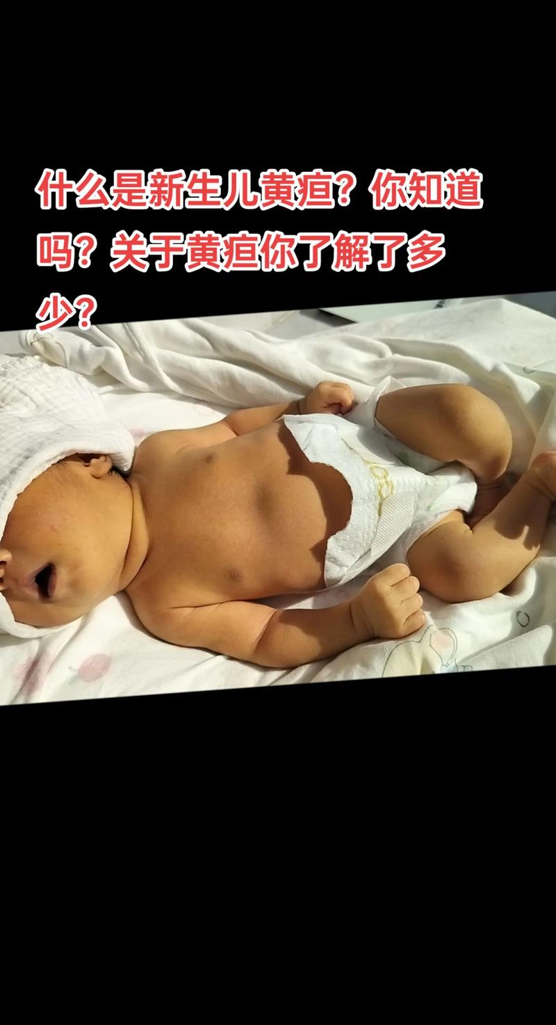 新生儿出生第三天黄疸值偏高需要干预吗？-第2张图片-郑州医学网
