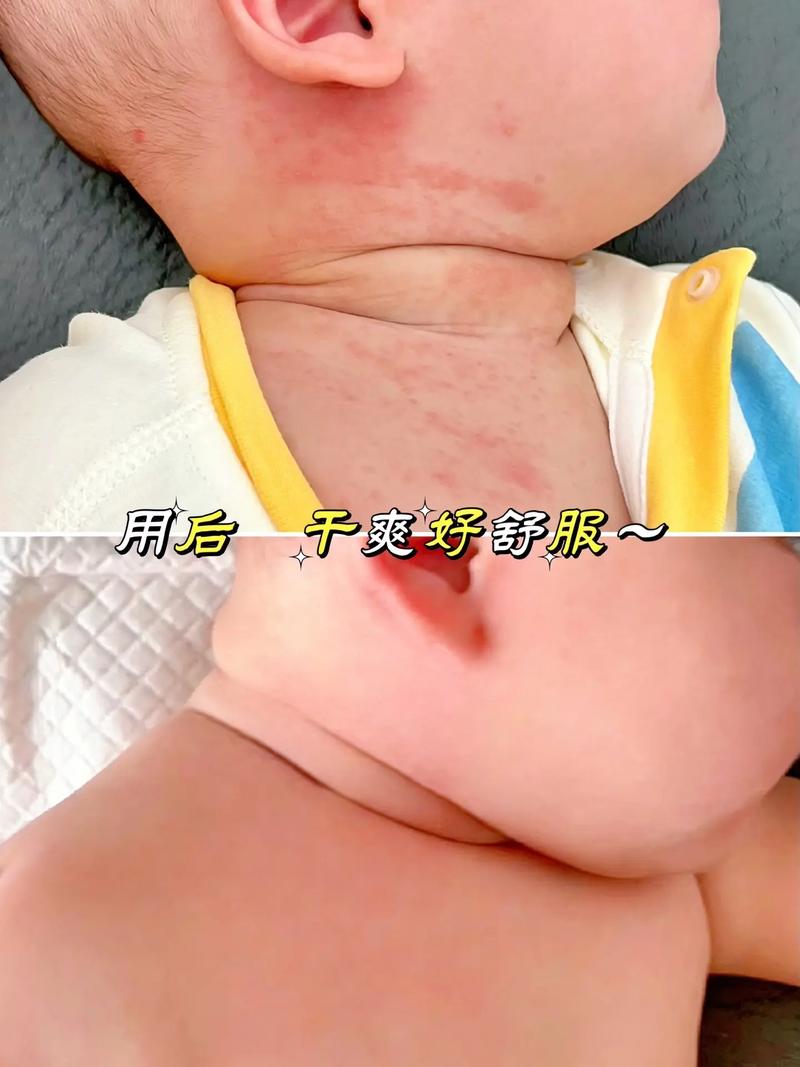 新生儿皮肤娇嫩,用爽身粉真的安全吗?会引发健康隐患吗?-第2张图片-郑州医学网 新生儿皮肤娇嫩,用爽身粉真的安全吗?会引发健康隐患吗?-第2张图片-郑州医学网